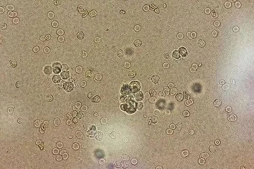 分泌物清洁度二度是什么意思_1