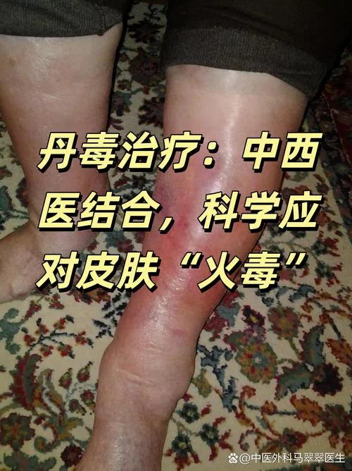什么是丹毒及临床表现_2