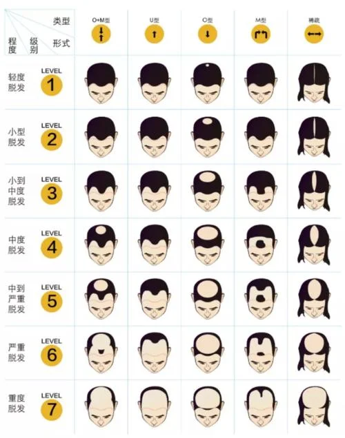 什么是男性脱发信息_2