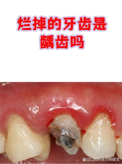 梦见牙齿有牙垢_1