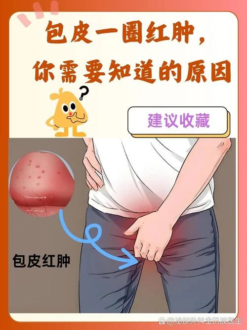 什么是霉菌包皮龟头炎图片_2