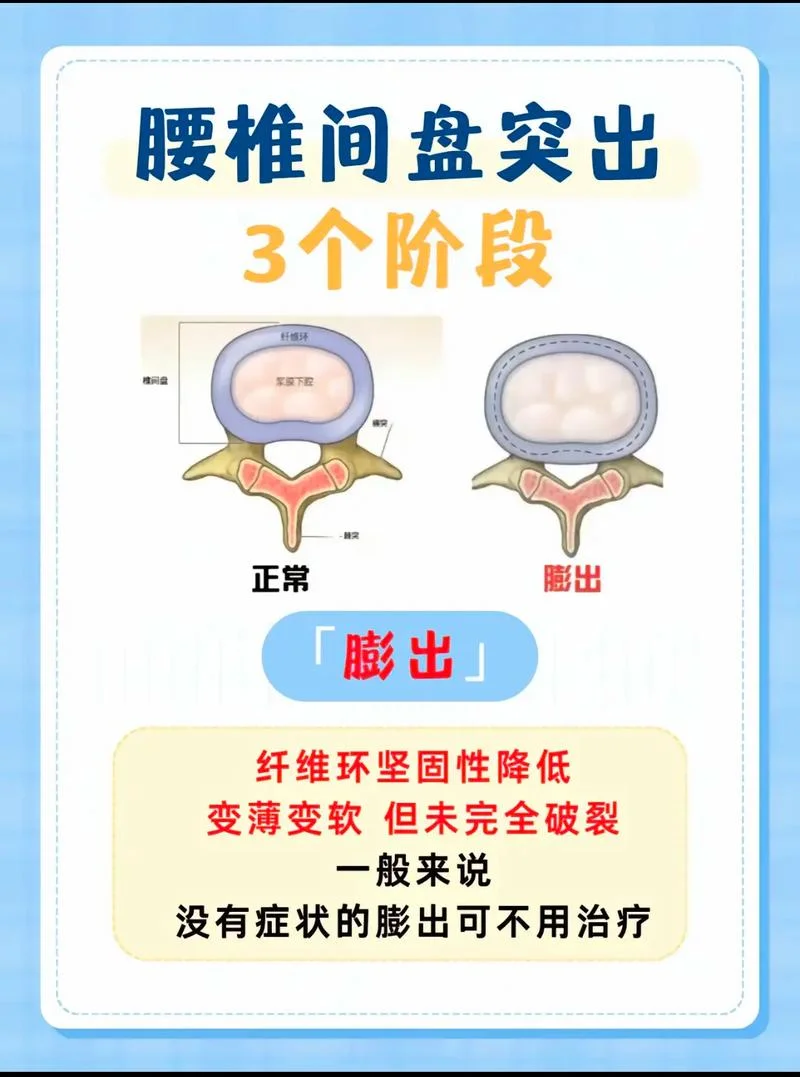 怀孕了腰间盘突出怎么办-怀孕腰突怎么办