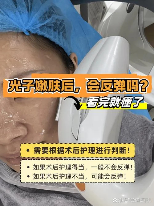 什么是光子除皱_2