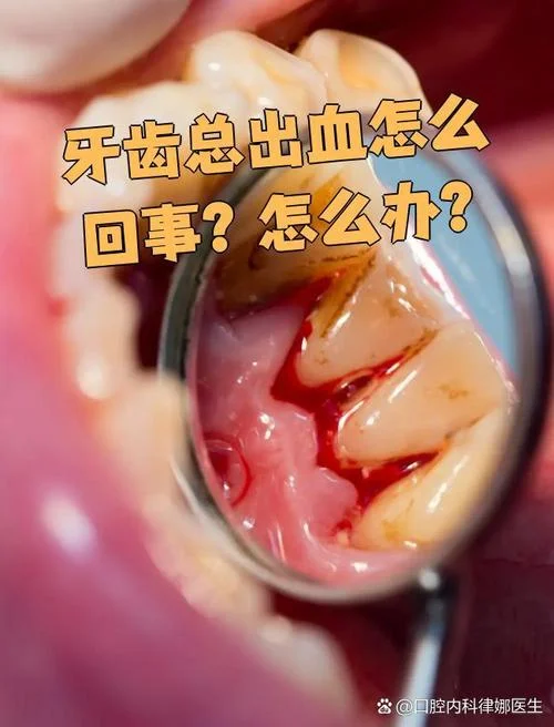 做梦刷牙出血掉牙-梦到刷牙出血掉牙