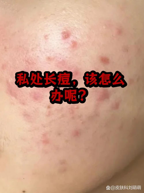 下体上长痘痘是为什么_1