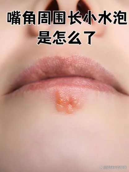 下嘴唇内侧起泡怎么办-下嘴唇起泡怎么办