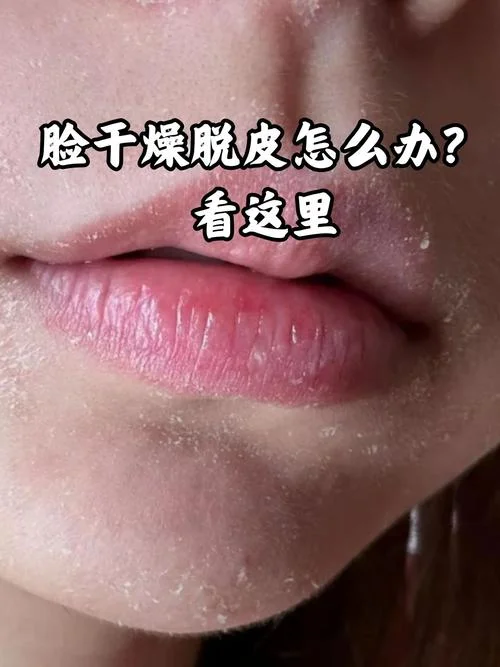 冬季脸特别干燥怎么办-冬季干脸怎么办