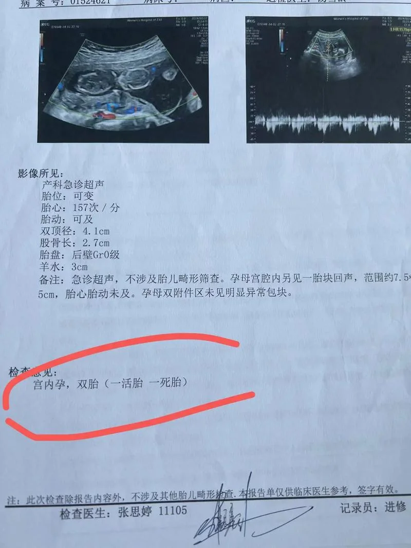怀孕梦到孩子没了_2