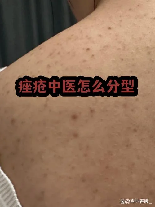 痤疮中医叫什么病_1