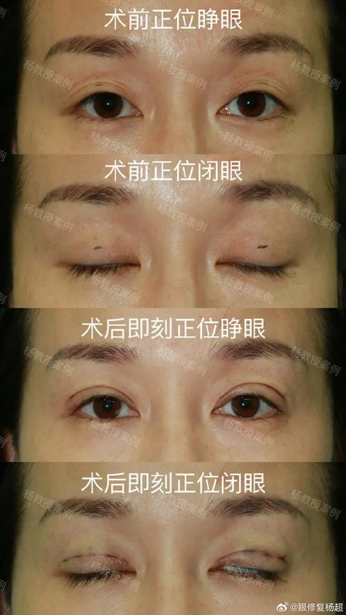 什么是重睑手术_1