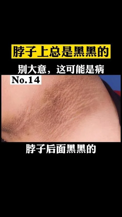 脖子起皮发黑怎么办-脖子起皮黑皮怎么治，