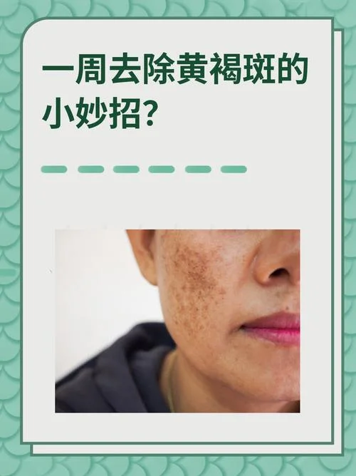 长斑怎么办去除-长斑去除妙招