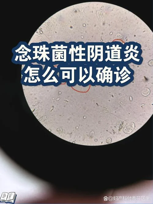 白带像豆腐渣阴部痒是为什么-豆腐渣白带伴瘙痒病因