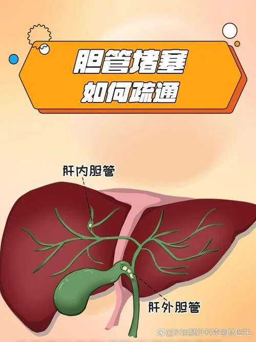 如何查胆总管炎-怎样查胆总管炎