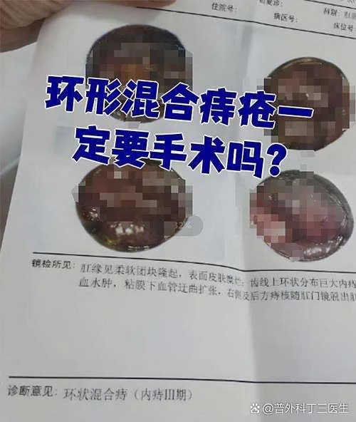 什么是环状内外混合痔_1