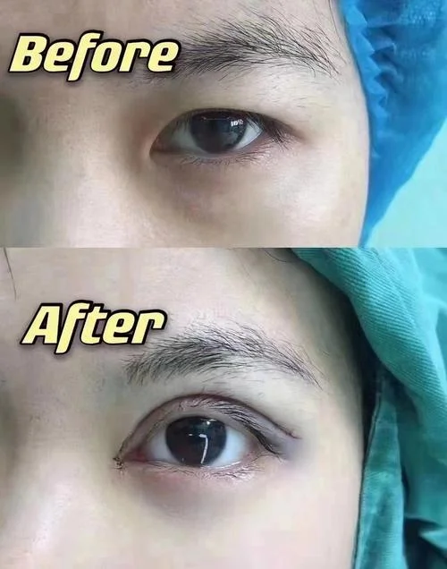 学开双眼皮微整哪里有_2
