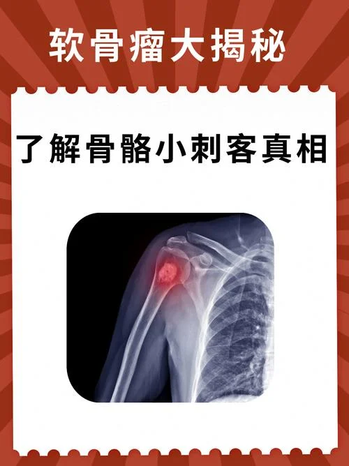 什么是软骨癌_1