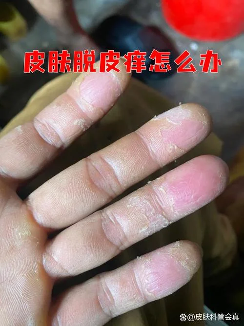 皮肤瘙痒症怎么办-皮肤瘙痒怎么办