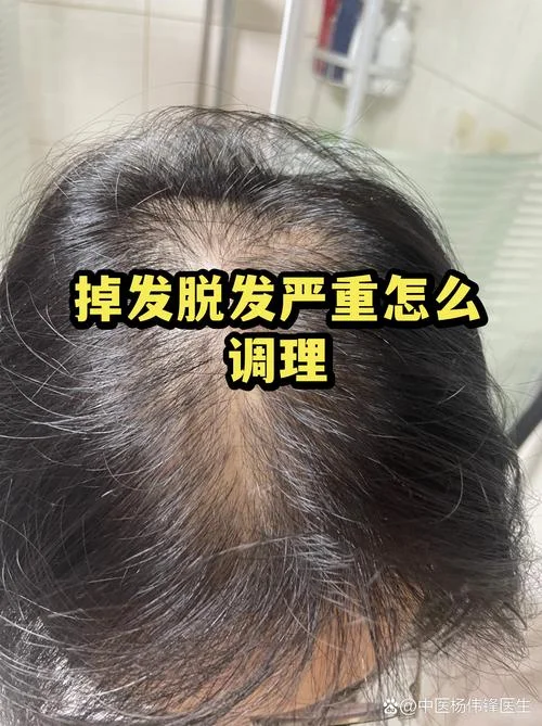 做梦洗头严重掉发_1