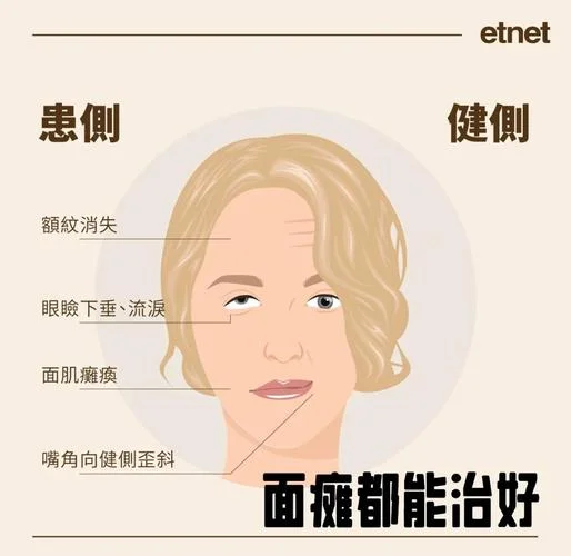 梦见自己面瘫-梦见面瘫