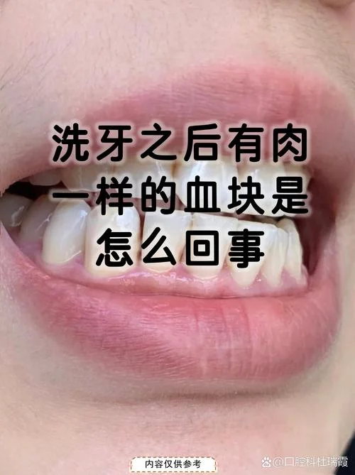 做梦梦到牙龈出血-牙龈出血梦境关键词