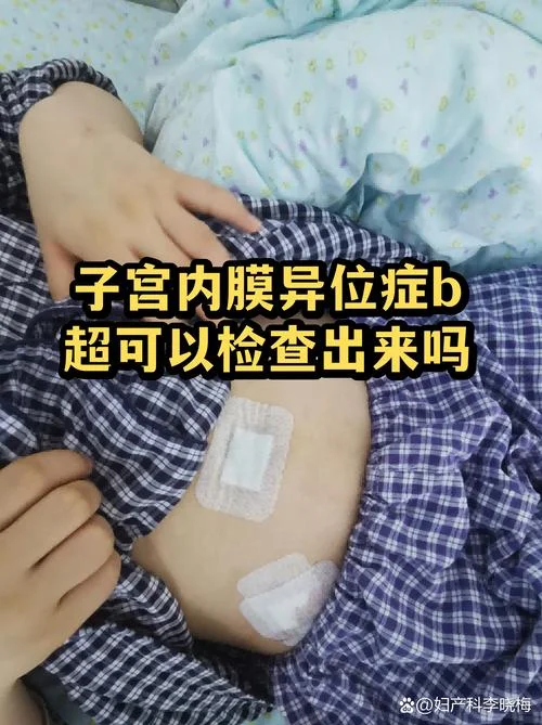 如何查卵巢异位_1