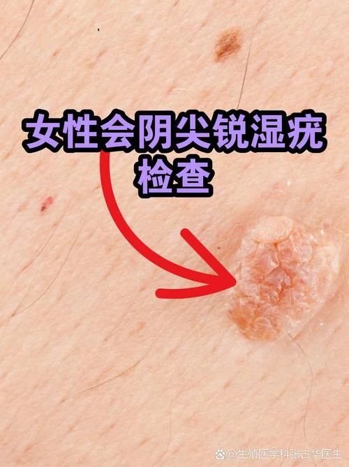 hpv检查全名叫什么_1