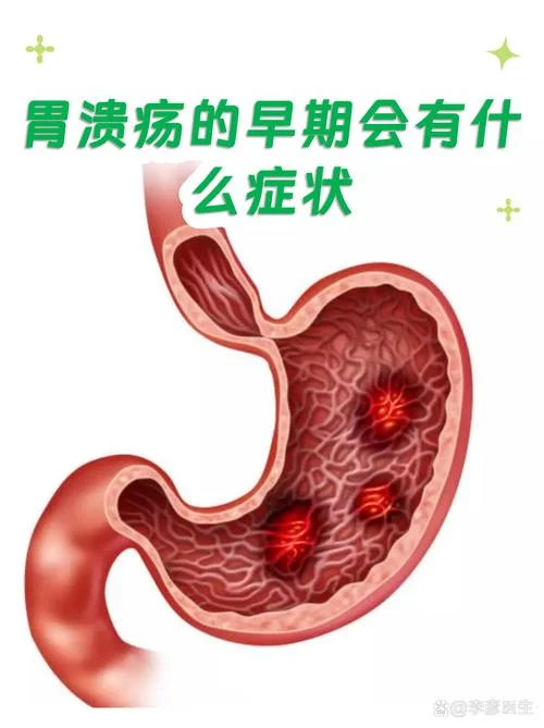 什么是消化性溃疡_2