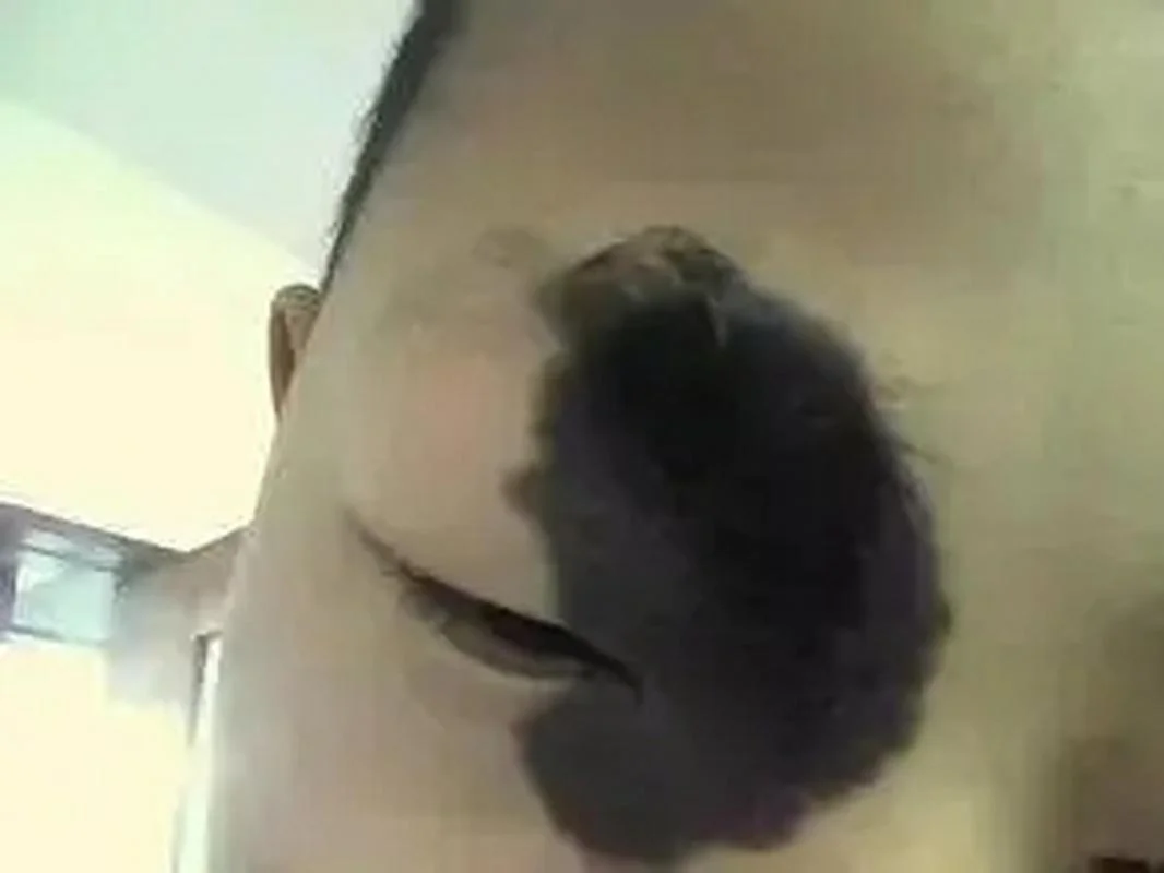 婴儿黑色胎记叫什么_2