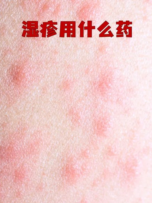 皮肤瘙痒症中医叫什么-中医皮肤病痒症