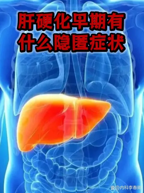 什么是肝硬化?早期肝硬化有哪些症状?_2