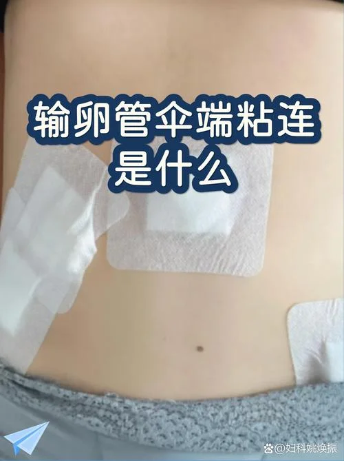 什么是输卵管峡部_1
