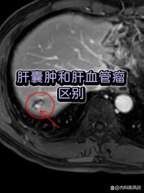 肝血管瘤的形成条件_1