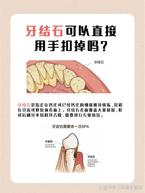 梦见牙结石掉了怎么办-梦见牙结石脱落