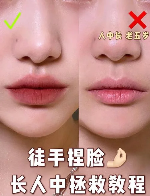 什么是人中缩短术_2