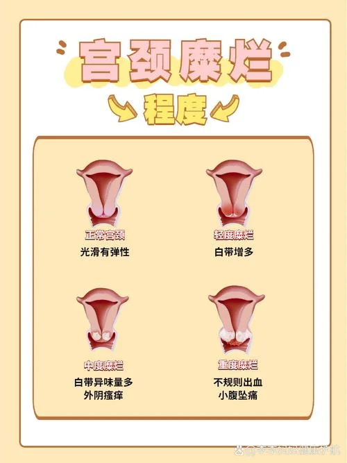 什么是宫颈糜烂电灼术_1