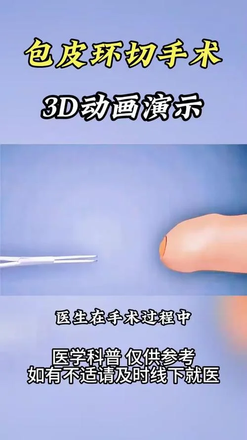 包皮环切吻合器原理_2