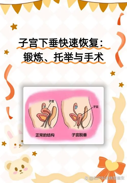 子宫下垂怎么做修复-子宫下垂修复术