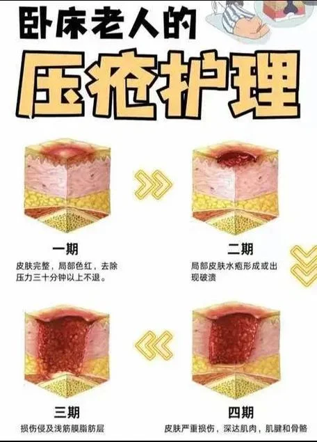 褥疮黑痂怎么办-褥疮黑痂如何护理