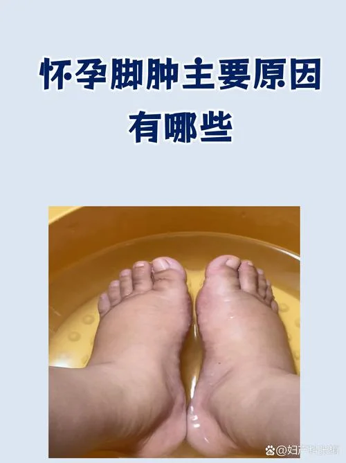 刚怀孕得了脚气怎么办-刚怀孕脚气怎么办