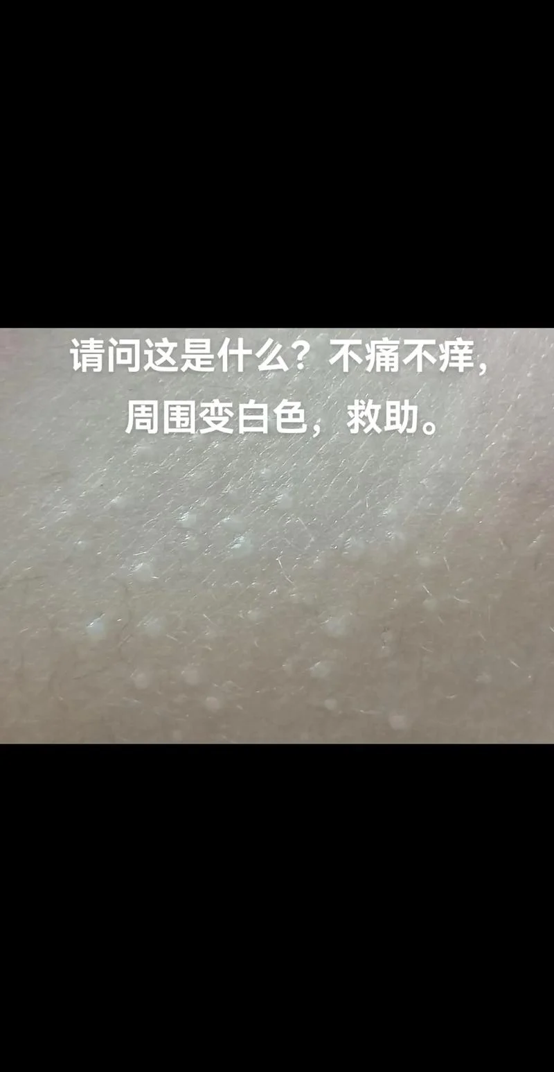 身上长白块是为什么_1