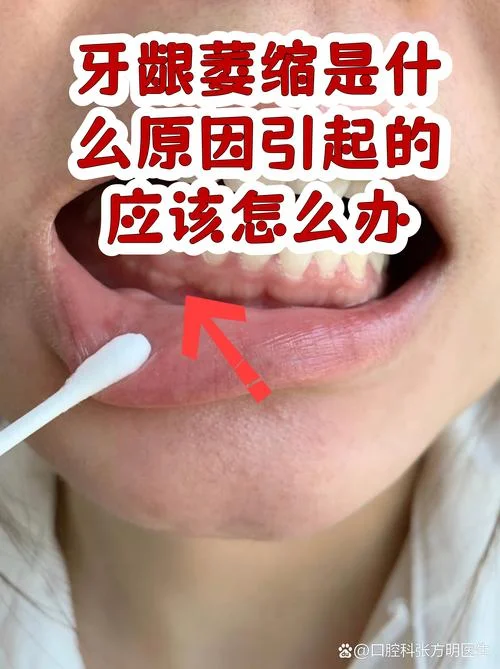 牙龈萎缩叫什么_2