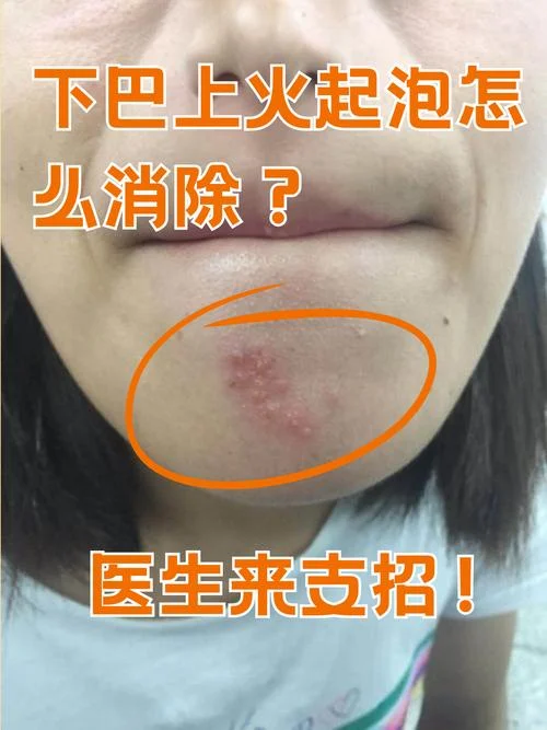 下巴很多粉刺怎么办-下巴粉刺多怎么办