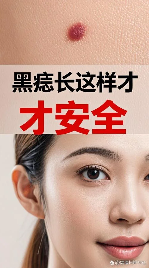 高出皮肤的痣叫什么痣_1