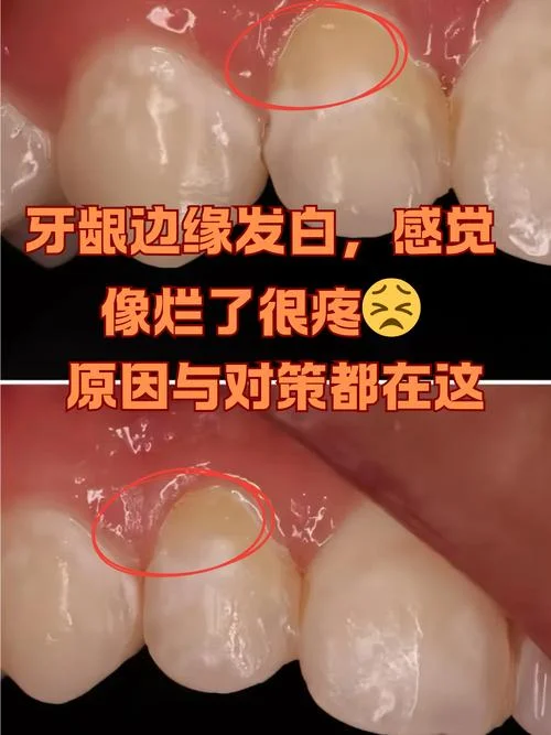 刷牙出血为什么是白色_1
