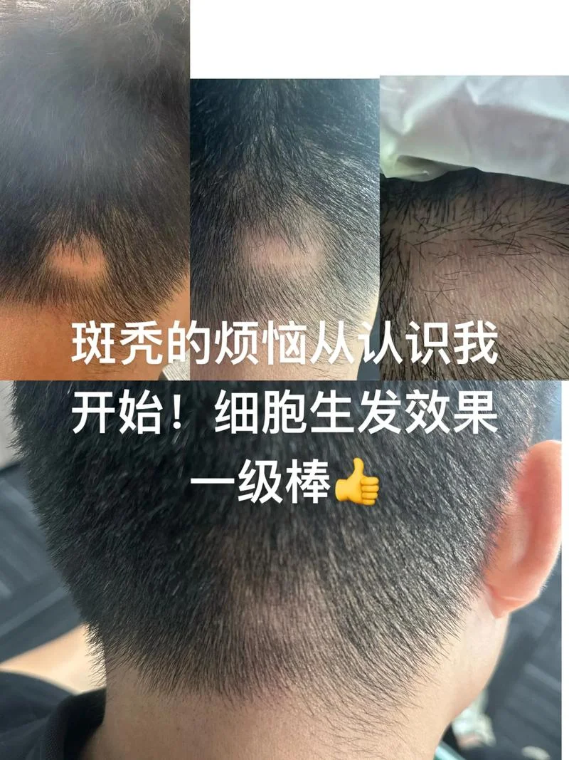 梦见自己掉头发斑秃_2