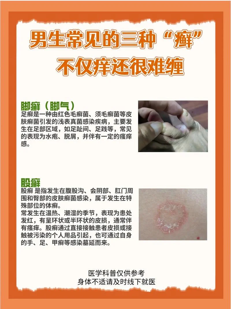 什么是癣的症状_2