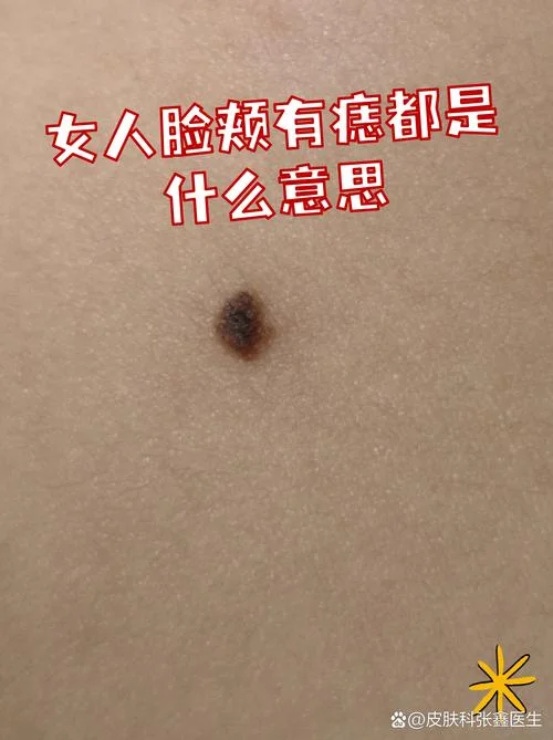 脸颊旁边的痣叫什么痣_1