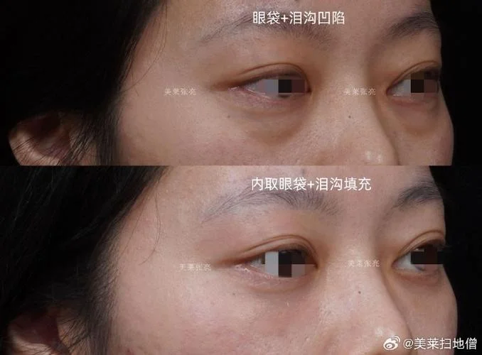 眼袋抽脂手术怎么做_1