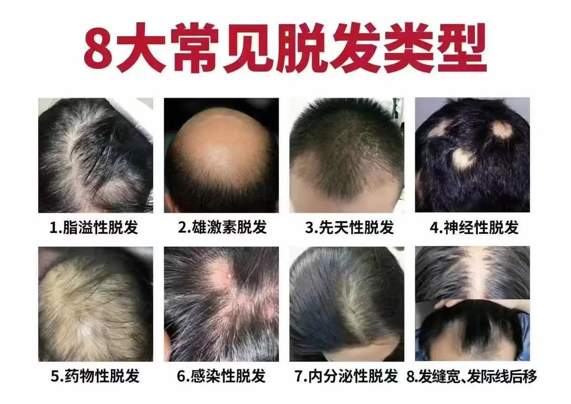 什么是重度脱发_1